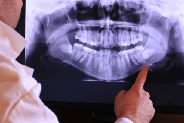 Best Emergency Tooth Extraction in Mineral Wells, TX
