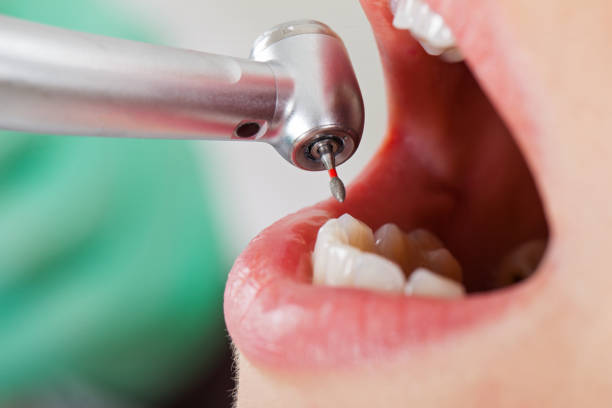 Best Emergency Wisdom Teeth Removal in Mineral Wells, TX